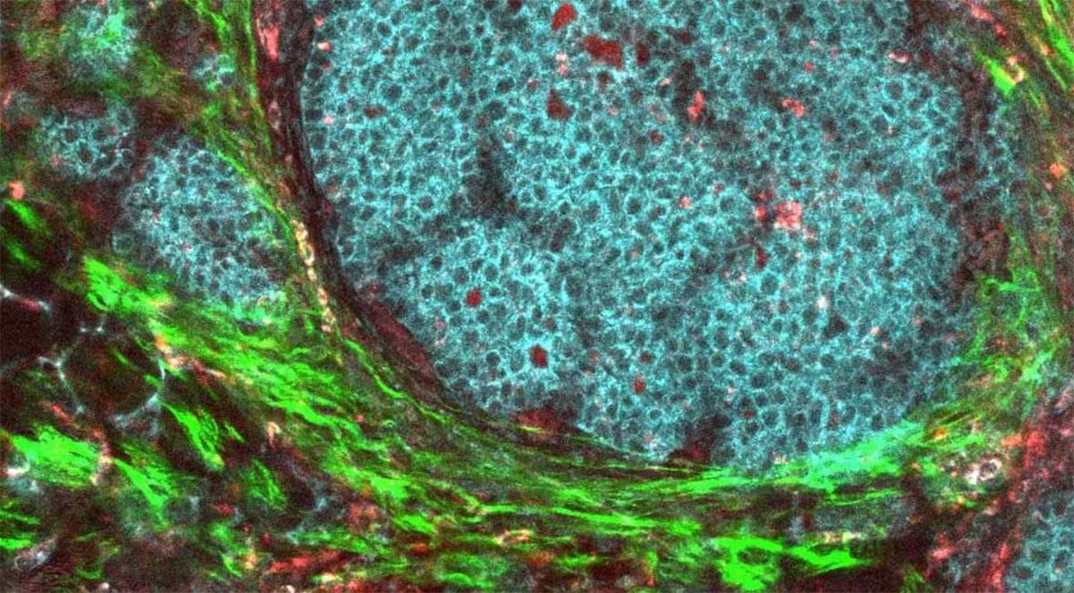 Breast cancer tumor microenvironment